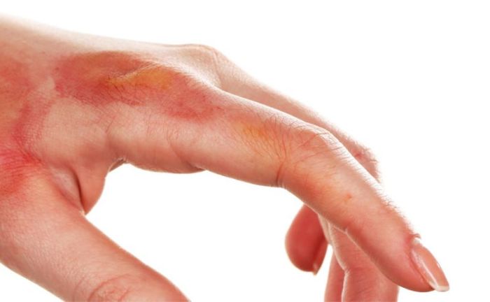 Chemical Burns · Types, Complications, Management How to burn calories