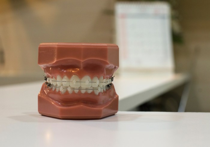 Helping your child accept their braces
