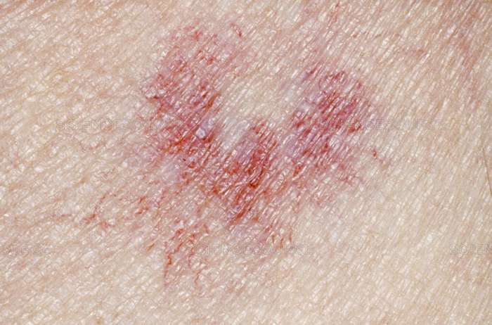 10 Warning Signs Of Autoimmune Liver Disease And Treatment - News18 10 warning signs liver diseases